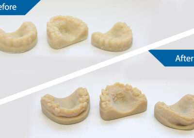 3D Teeth Molds Before and After